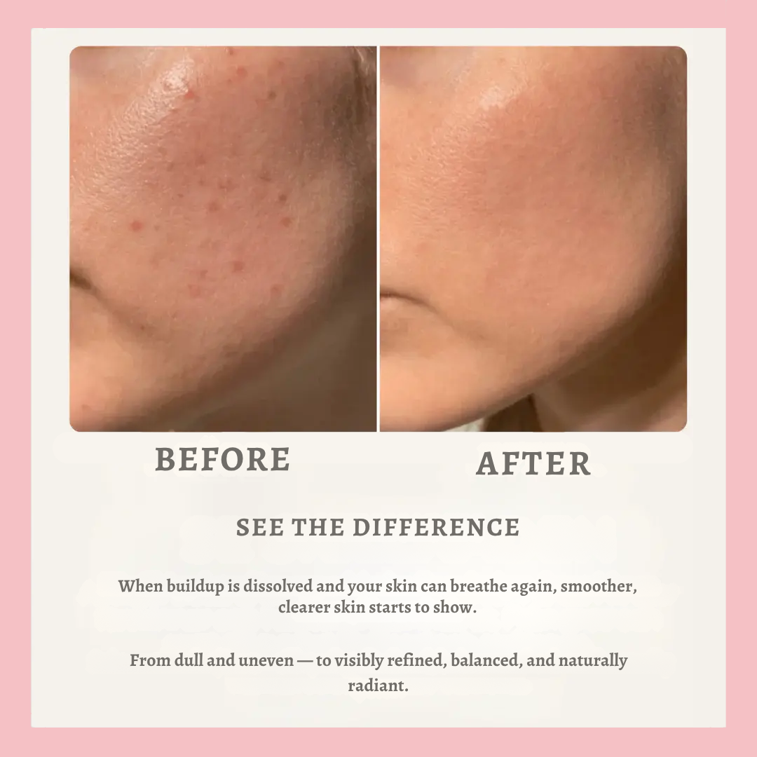 Cleanskin- Clearer skin without visible pores